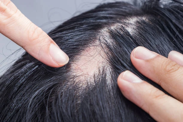 Alopecia Areata image 1