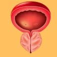 Prostatitis image 2