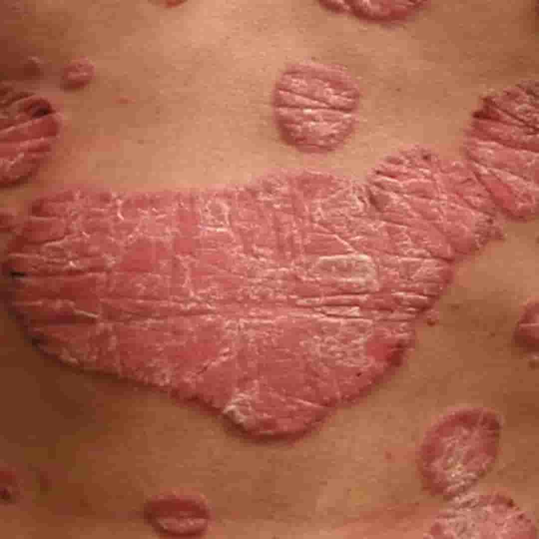 Psoriasis image 1