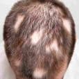 Alopecia Areata